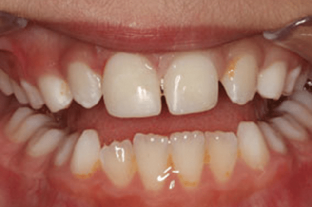 Smile Makeover after at D'Angelo/Olson La Jolla Dentistry in San Diego, CA