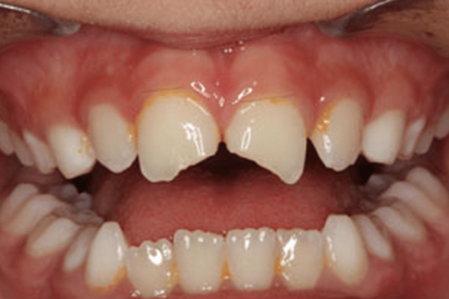 Smile Makeover before at D'Angelo/Olson La Jolla Dentistry in San Diego, CA