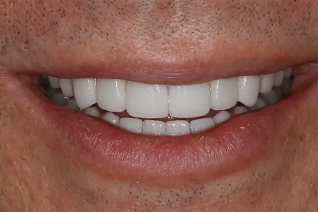 Smile Makeover after at D'Angelo/Olson La Jolla Dentistry in San Diego, CA