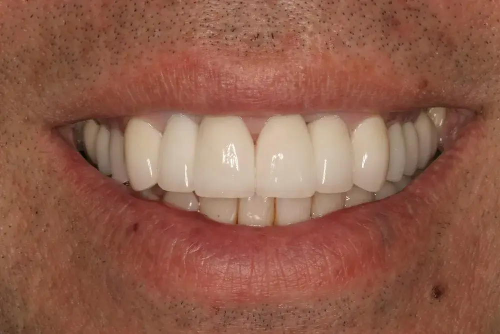 D'Angelo/Olson La Jolla Dentistry veneers after — San Diego, CA
