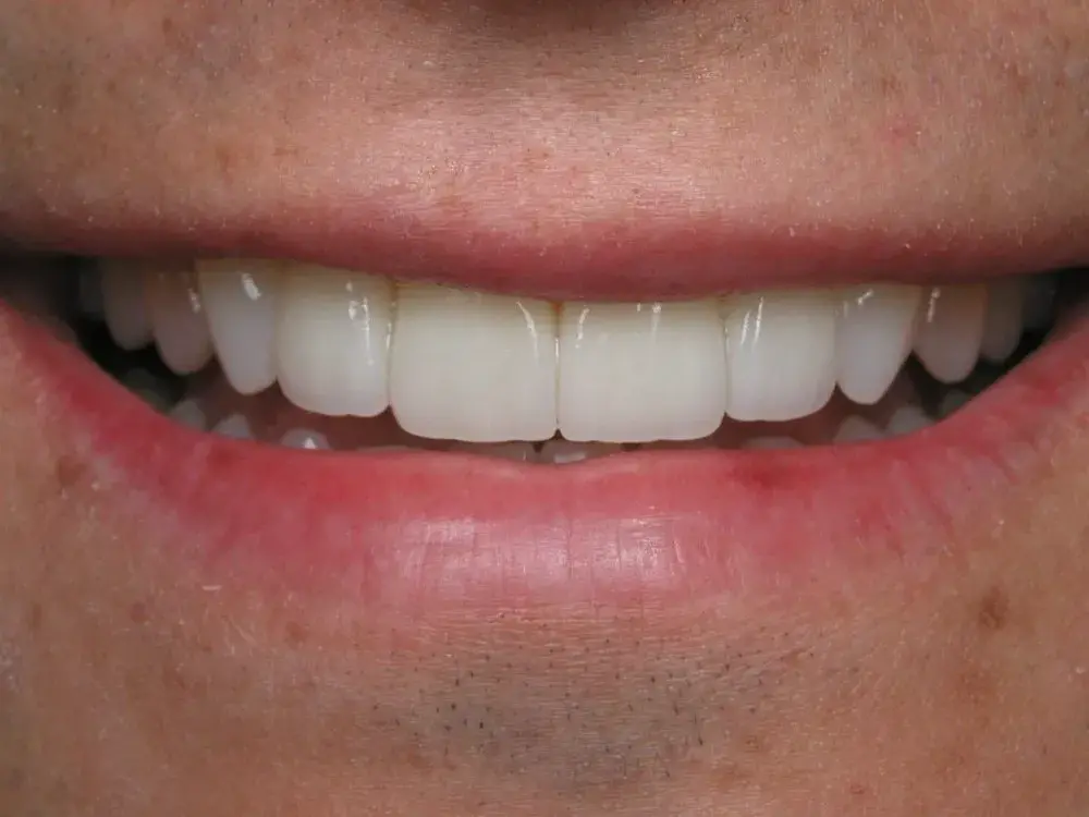 D'Angelo/Olson La Jolla Dentistry veneers after — San Diego, CA