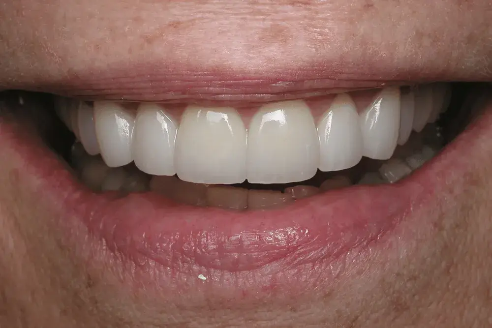 D'Angelo/Olson La Jolla Dentistry veneers after — San Diego, CA