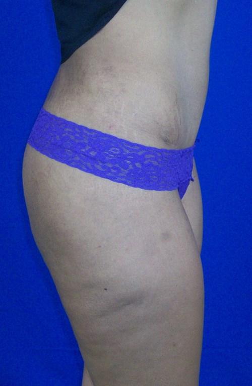 Tummy Tuck after at VIP Plastic Surgery in Henderson, NV