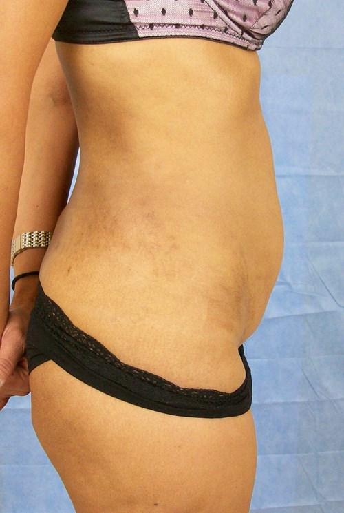 Tummy Tuck before at VIP Plastic Surgery in Henderson, NV