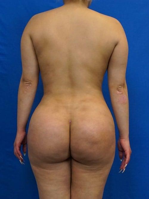 Liposuction after at VIP Plastic Surgery in Henderson, NV