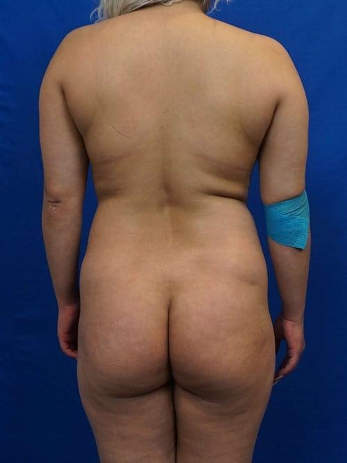 Liposuction before at VIP Plastic Surgery in Henderson, NV
