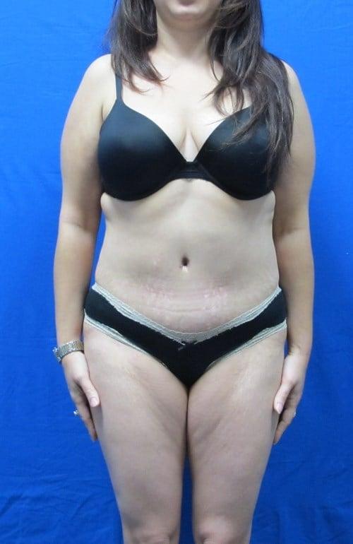 Tummy Tuck after at VIP Plastic Surgery in Henderson, NV