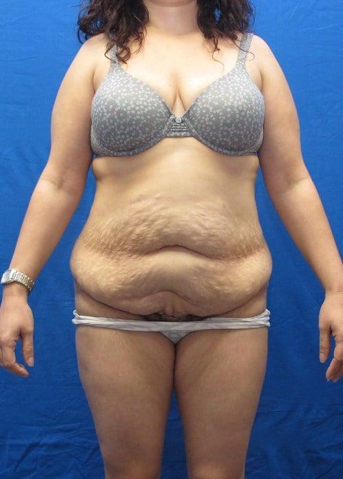 Tummy Tuck before at VIP Plastic Surgery in Henderson, NV
