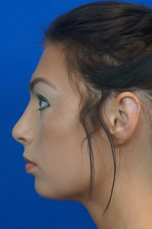 Liposuction after at VIP Plastic Surgery in Henderson, NV