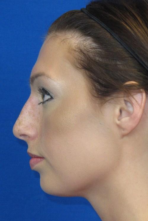 Liposuction before at VIP Plastic Surgery in Henderson, NV