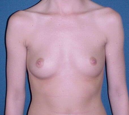 Breast Augmentation before at VIP Plastic Surgery in Henderson, NV