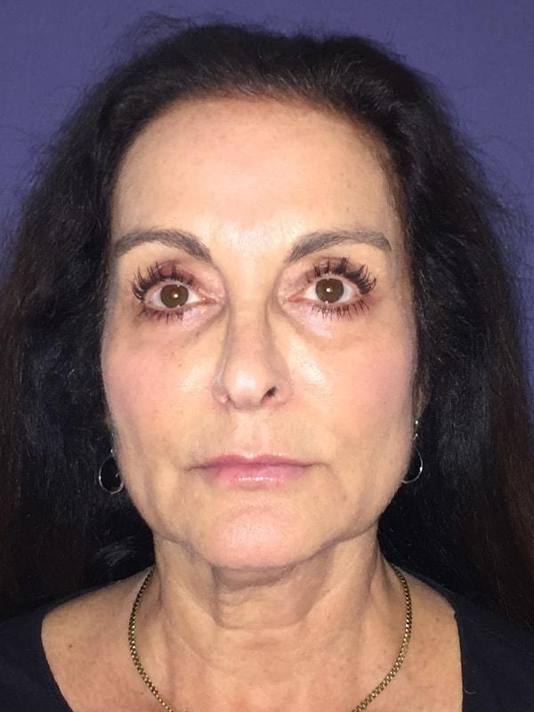 Neck Lift before at Cosmoplastic Surgery (Kaveh Alizadeh, MD) in Jericho, NY