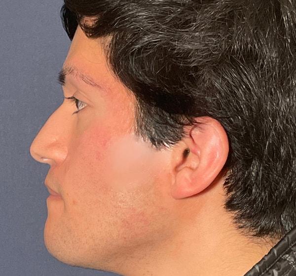 Liquid Rhinoplasty before at Cosmoplastic Surgery (Kaveh Alizadeh, MD) in Jericho, NY