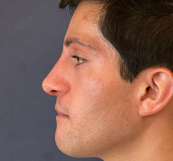Liquid Rhinoplasty after at Cosmoplastic Surgery (Kaveh Alizadeh, MD) in Jericho, NY