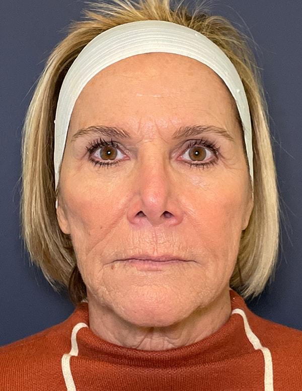 Neck Lift before at Cosmoplastic Surgery (Kaveh Alizadeh, MD) in Jericho, NY