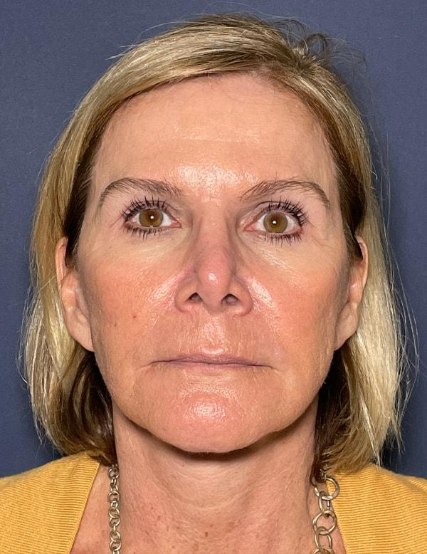 Neck Lift after at Cosmoplastic Surgery (Kaveh Alizadeh, MD) in Jericho, NY