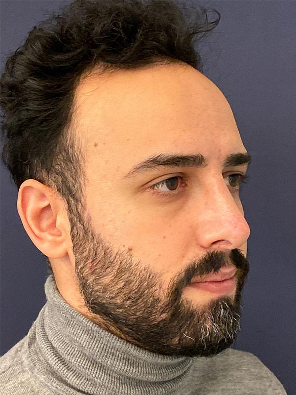 Cosmoplastic Surgery (Kaveh Alizadeh, MD) scar treatment after — Jericho, NY