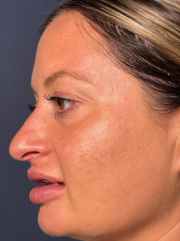 Liquid Rhinoplasty before at Cosmoplastic Surgery (Kaveh Alizadeh, MD) in Jericho, NY