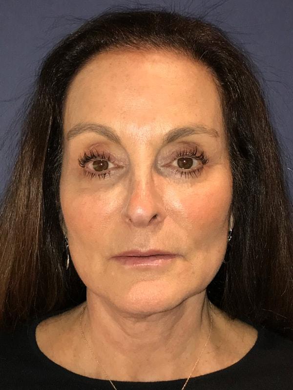 Neck Lift after at Cosmoplastic Surgery (Kaveh Alizadeh, MD) in Jericho, NY