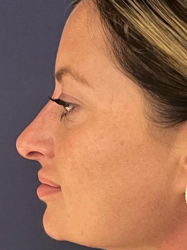 Liquid Rhinoplasty after at Cosmoplastic Surgery (Kaveh Alizadeh, MD) in Jericho, NY