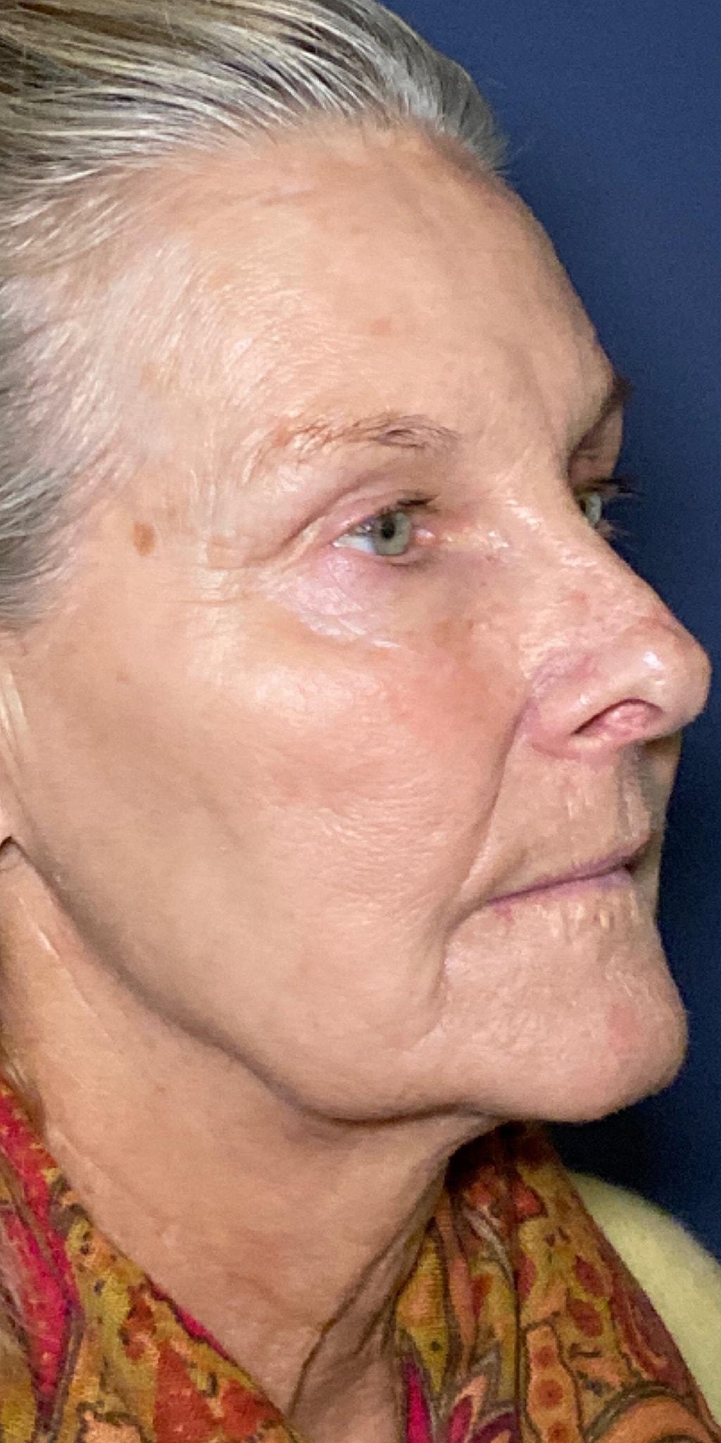 Cosmoplastic Surgery (Kaveh Alizadeh, MD) photofacial after — Jericho, NY