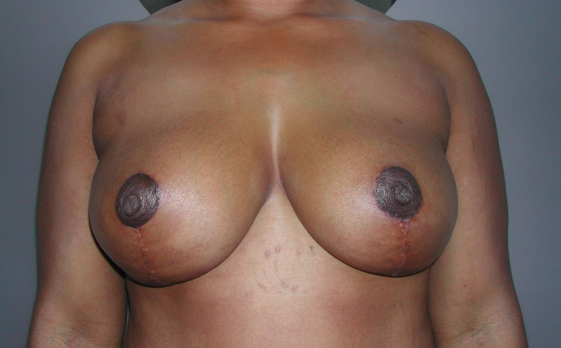 Cosmoplastic Surgery (Kaveh Alizadeh, MD) breast reduction after — Jericho, NY