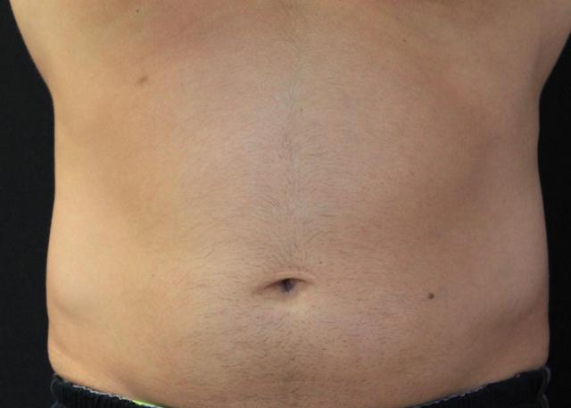 CoolSculpting before at Oasis Med Spa at WSNM in Albuquerque, NM