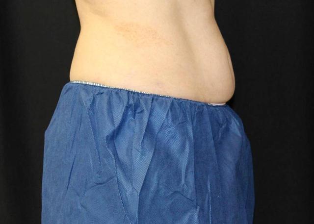 CoolSculpting before at Oasis Med Spa at WSNM in Albuquerque, NM