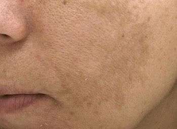 Laser Skin Resurfacing before at Oasis Med Spa at WSNM in Albuquerque, NM
