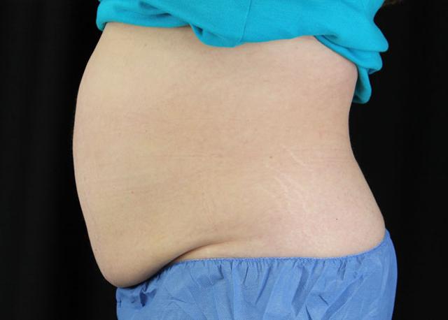 CoolSculpting before at Oasis Med Spa at WSNM in Albuquerque, NM