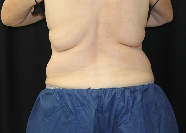 CoolSculpting before at Oasis Med Spa at WSNM in Albuquerque, NM