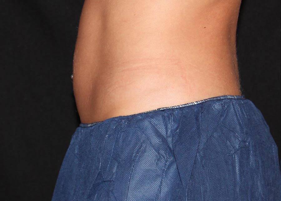 Oasis Med Spa at WSNM coolsculpting after — Albuquerque, NM