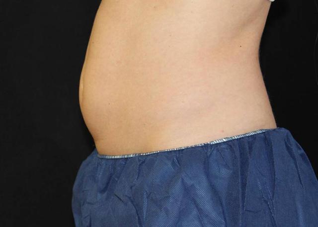 CoolSculpting before at Oasis Med Spa at WSNM in Albuquerque, NM