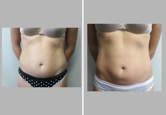 Brian D. Cohen, MD liposuction result — Great Neck, NY