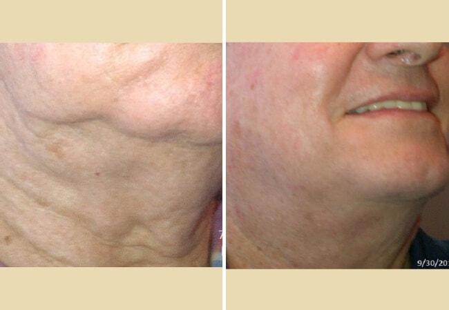 Brian D. Cohen, MD skin tightening result — Great Neck, NY
