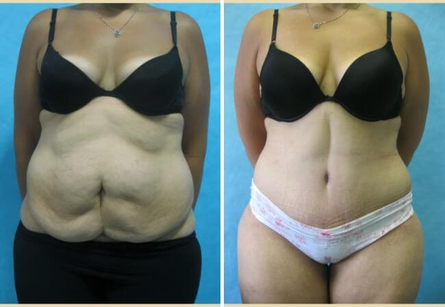 Brian D. Cohen, MD tummy tuck result — Great Neck, NY
