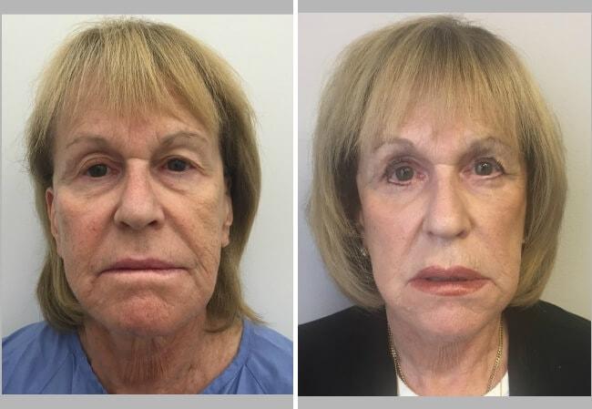 Brian D. Cohen, MD eyelid lift result — Great Neck, NY