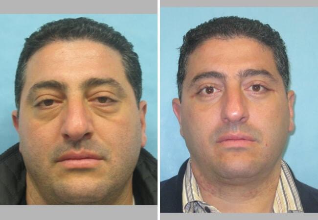 Brian D. Cohen, MD eyelid lift result — Great Neck, NY
