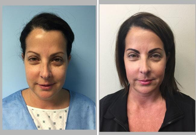 Brian D. Cohen, MD eyelid lift result — Great Neck, NY
