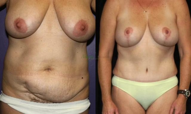 Mommy Makeover result at Murphy Plastic Surgery Group in Englewood, CO