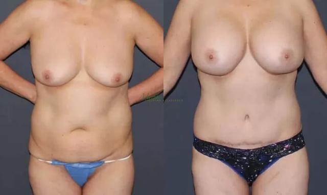 Mommy Makeover result at Murphy Plastic Surgery Group in Englewood, CO