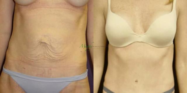 Mini Tummy Tuck result at Murphy Plastic Surgery Group in Englewood, CO