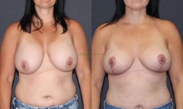 Breast Lift result at Murphy Plastic Surgery Group in Englewood, CO