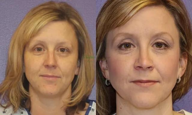Rhinoplasty result at Murphy Plastic Surgery Group in Englewood, CO