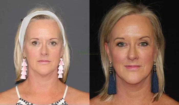 Murphy Plastic Surgery Group eyelid lift result — Englewood, CO