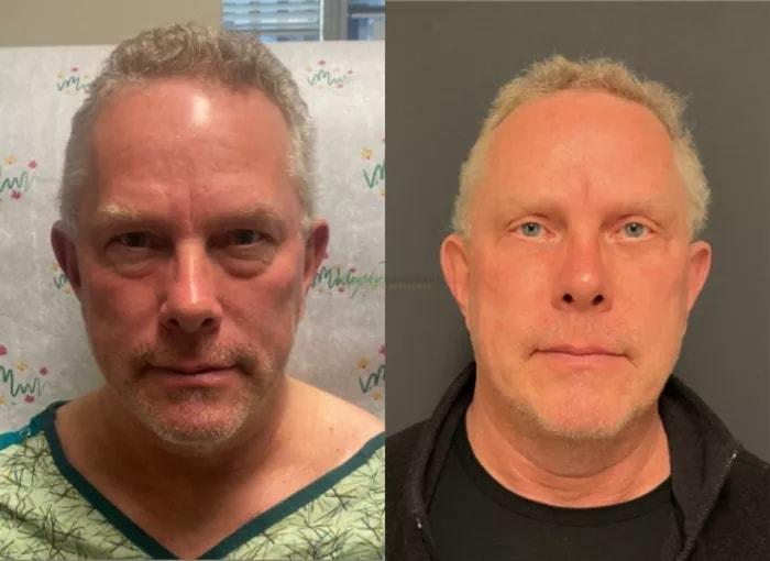 Murphy Plastic Surgery Group eyelid lift result — Englewood, CO