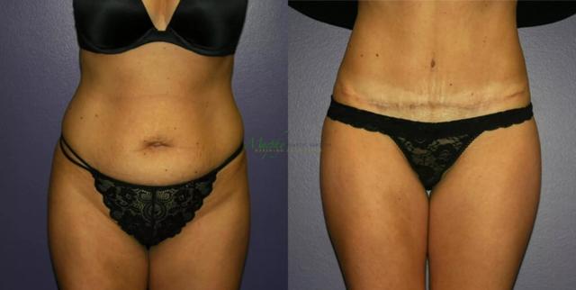 Mommy Makeover result at Murphy Plastic Surgery Group in Englewood, CO
