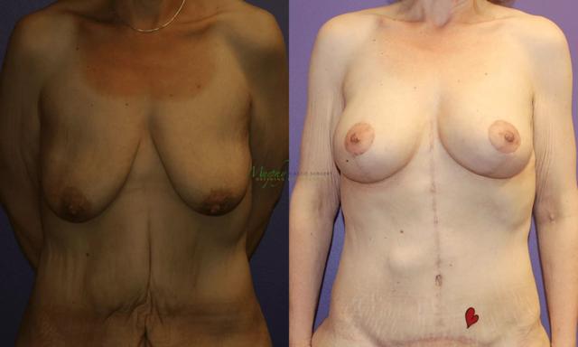 Mommy Makeover result at Murphy Plastic Surgery Group in Englewood, CO
