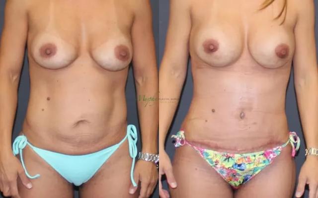 Mommy Makeover result at Murphy Plastic Surgery Group in Englewood, CO