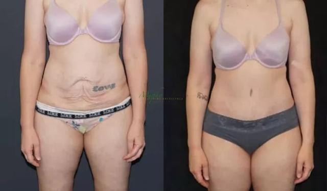 Mini Tummy Tuck result at Murphy Plastic Surgery Group in Englewood, CO